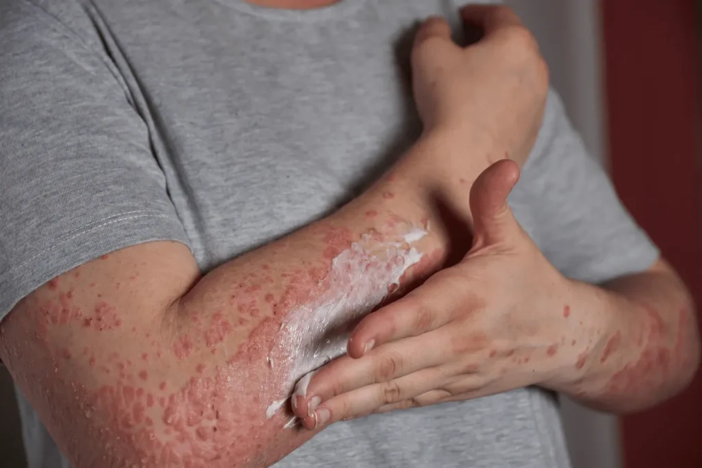 psoriasis